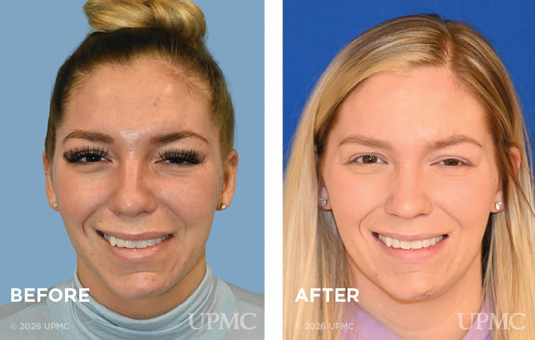 Patient with synkinesis before and after left DAO resection.